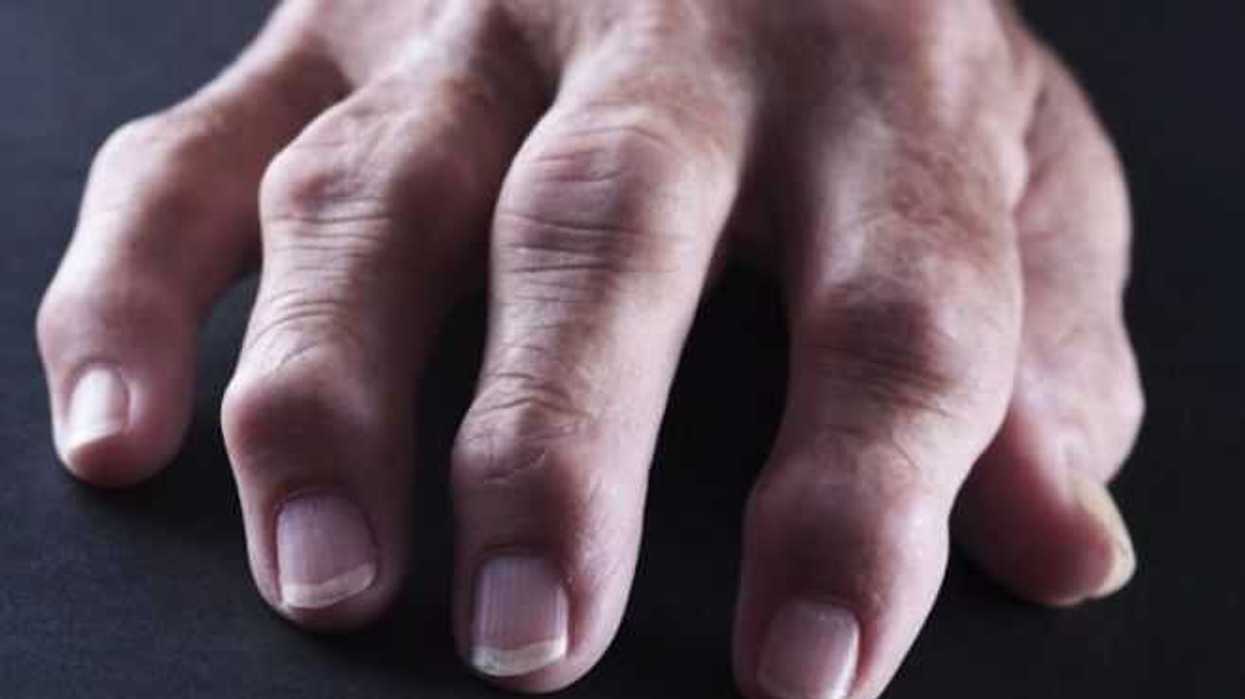 apoyo-a-pacientes-con-artritis-reumatoide