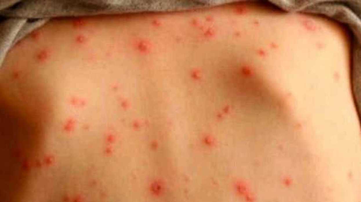 brote-de-sarampion-en-filipinas-causa-136-muertos-y-ocho-mil-400-casos