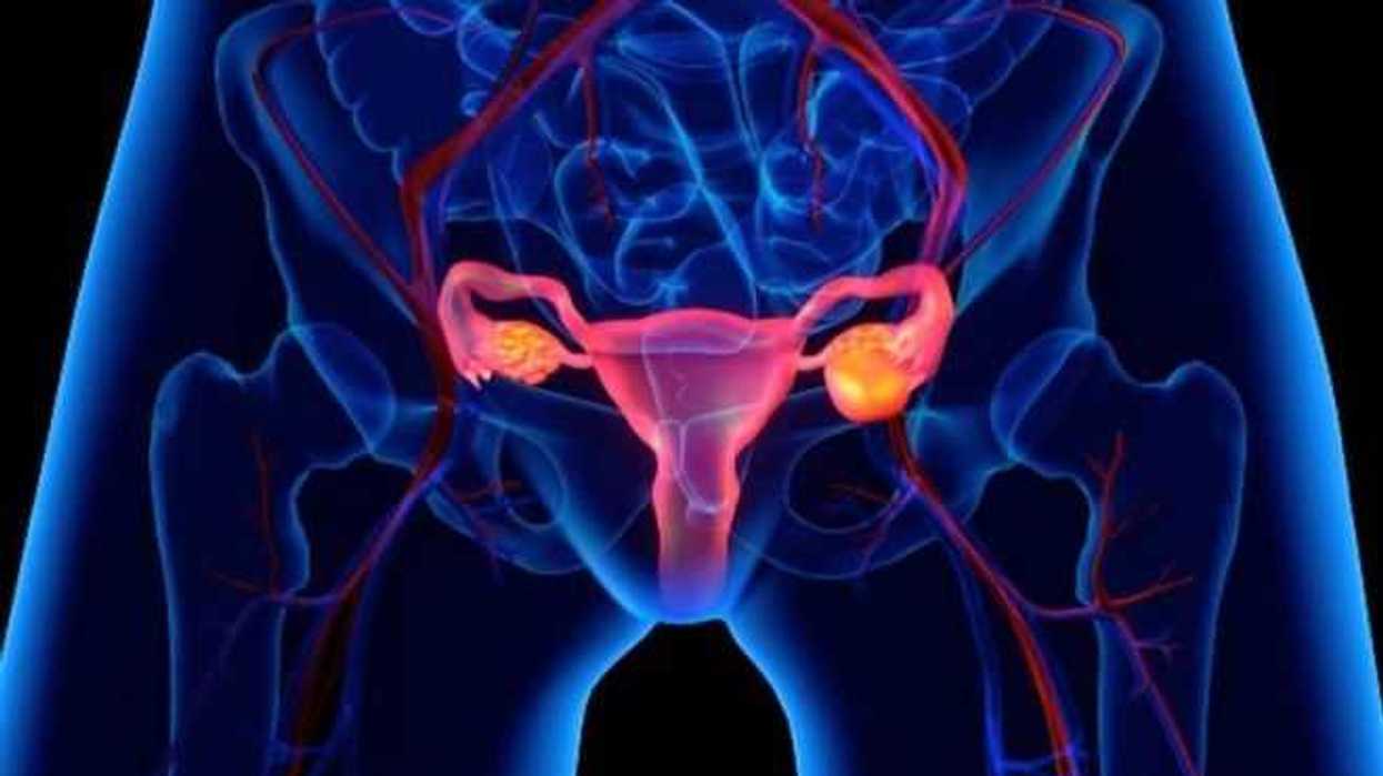 cancer-de-ovario-entre-las-enfermedades-ginecologicas-mas-letales