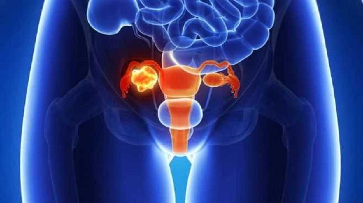 cancer-de-ovario-un-mal-silencioso-altamente-mortal-y-desatendido