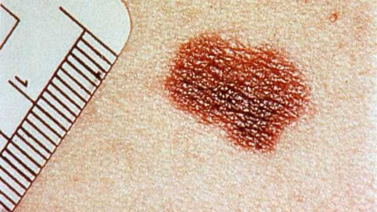cancer-piel-efe