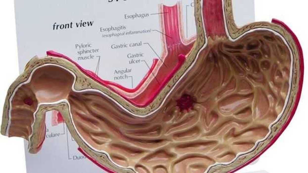 crean-dispositivo-expandible-para-rastrear-ulceras-en-el-estomago