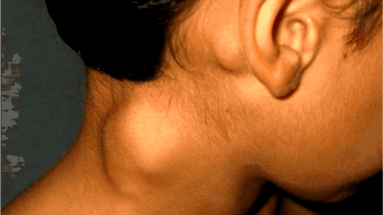 deteccion-temprana-factor-elemental-para-curar-el-linfoma-de-hodgkin