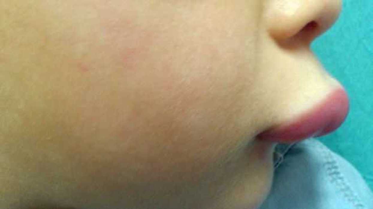 diagnostico-temprano-de-angioedema-mejora-calidad-de-vida-en-pacientes