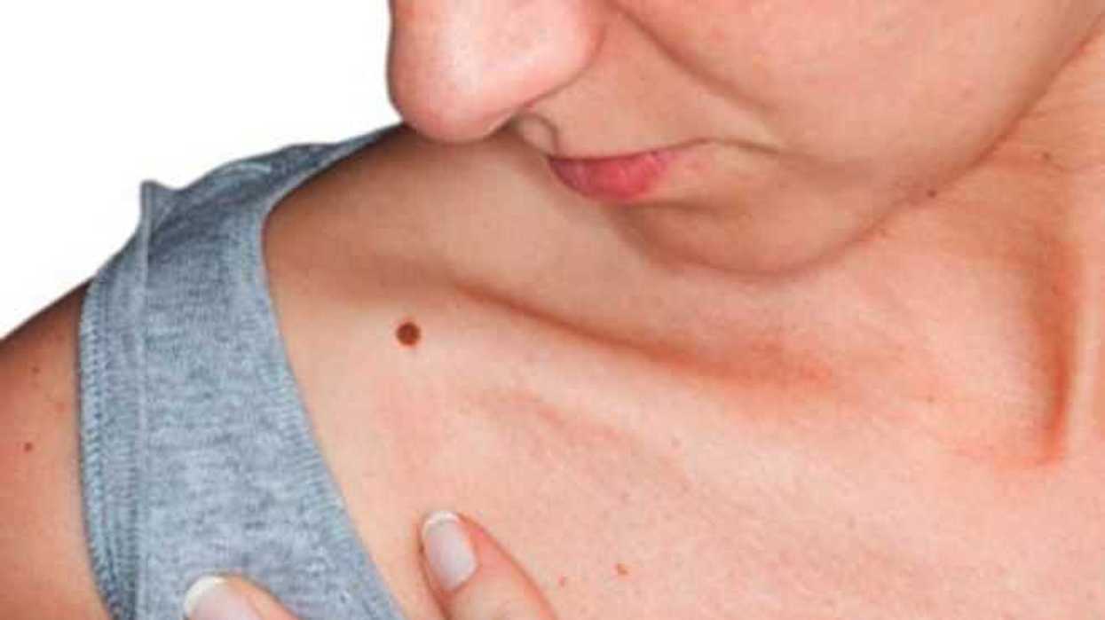 en-jalisco-pretenden-prevenir-cancer-piel-mucosa-bucal
