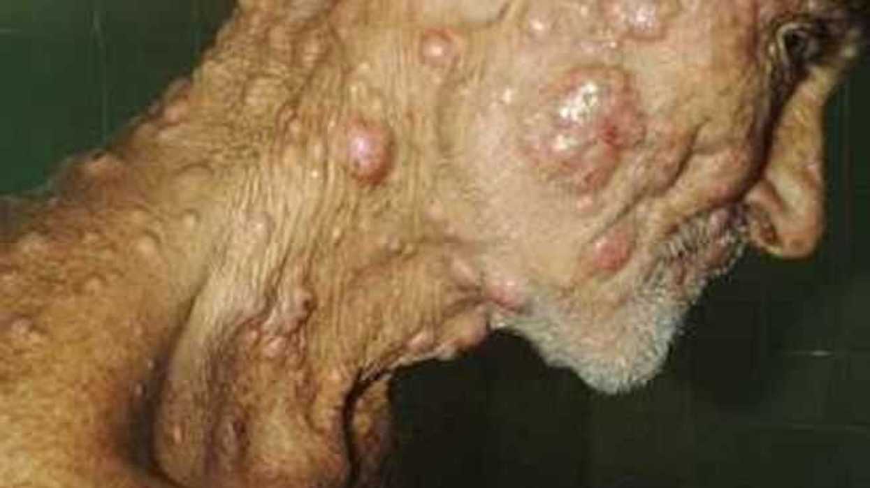 Enfermedad de lepra provoca úlceras cutáneas y daño neurológico.