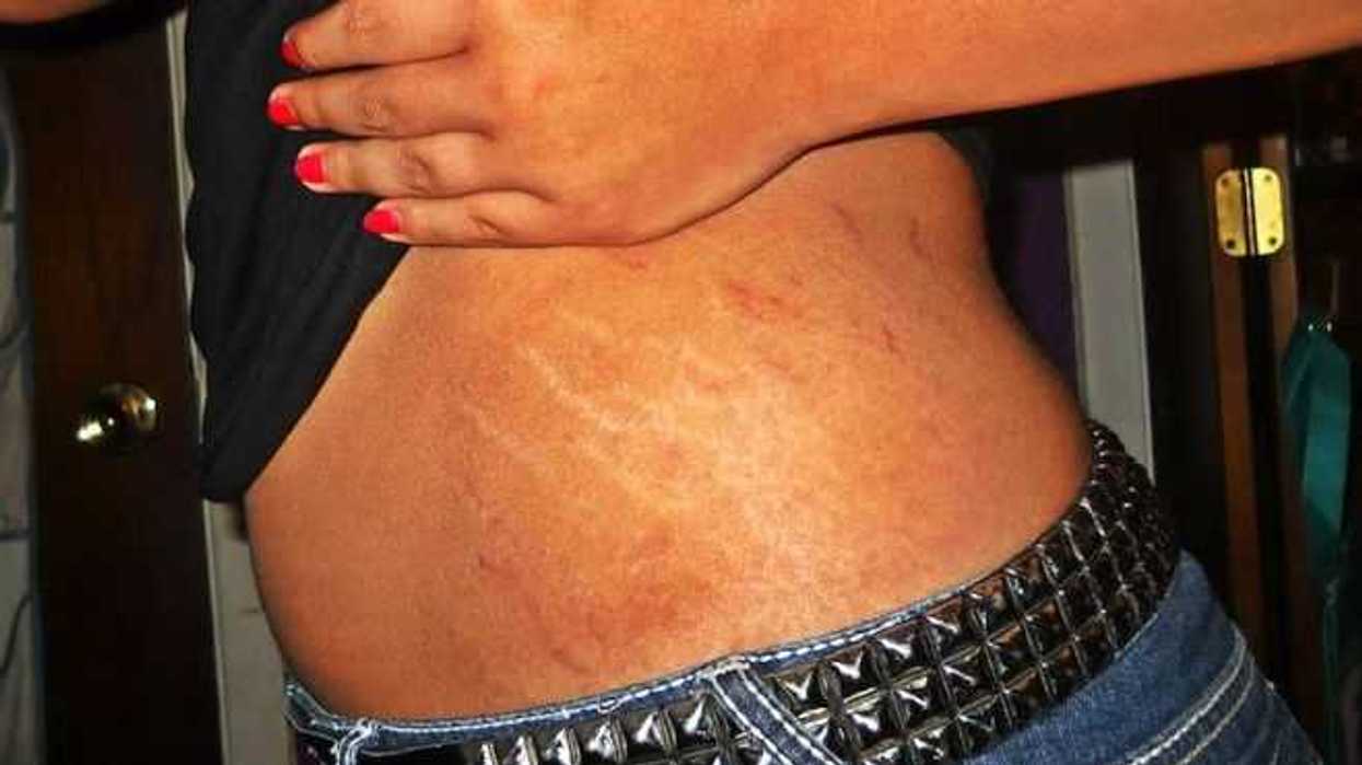 estrias-afecta-a-mas-de-la-mitad-de-las-adolescentes-senala-dermatologa