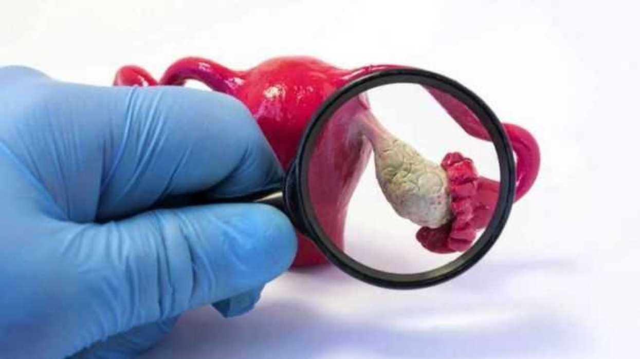 experto-advierte-sobre-sintomas-que-pueden-indicar-cancer-de-ovario