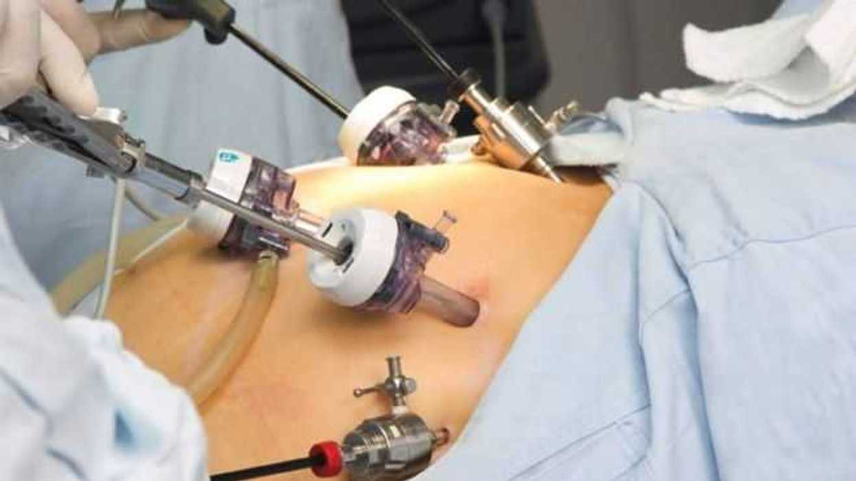 La cirugía bariátrica ayuda a controlar y en algunos casos a curar la diabetes mellitus. FOTO/ESPECIAL