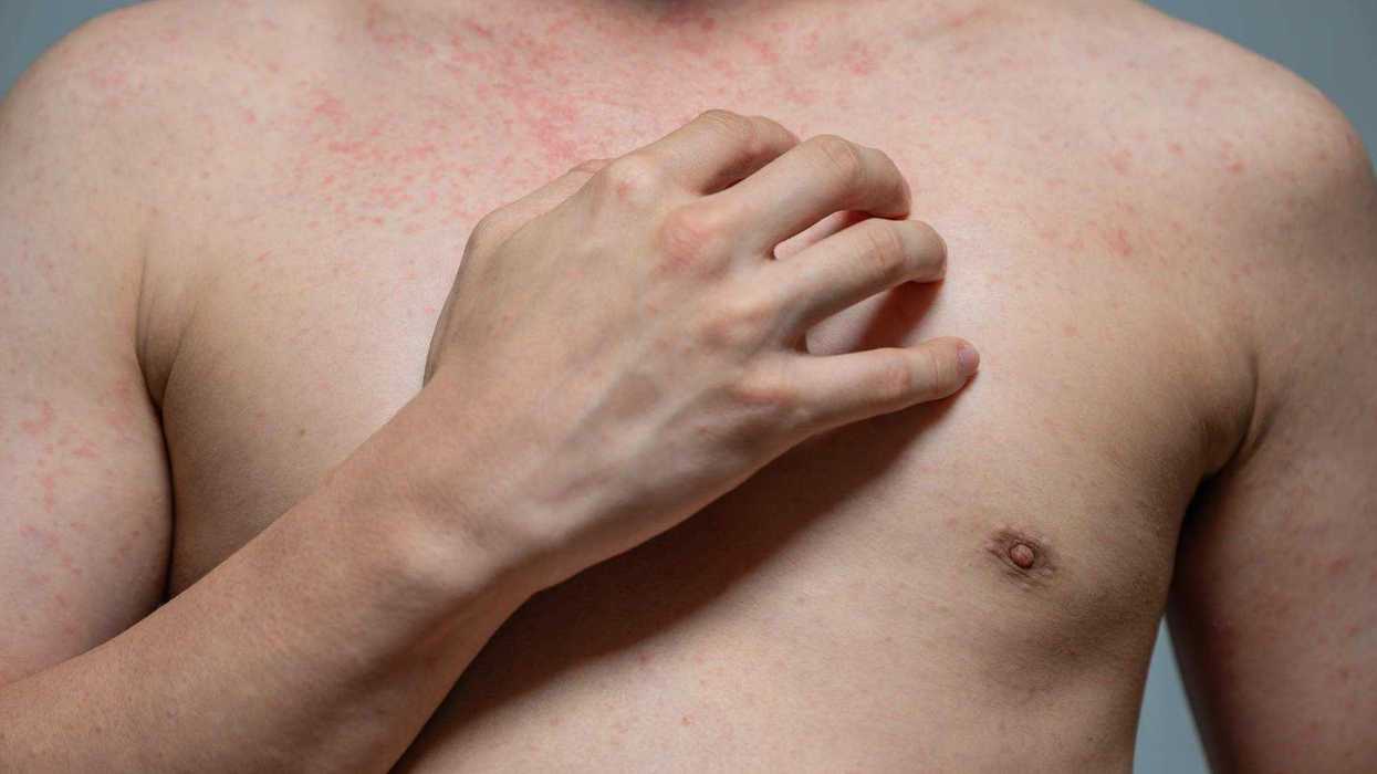 Los síntomas principales del sarampión incluyen fiebre, tos, sarpullido, ojos rojos, secreción y congestión nasal, según la Secretaría de Salud.