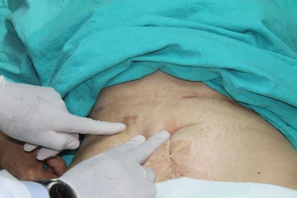 medicos del hospital la raza extraen hemangioma a mujer de 66 anos 1