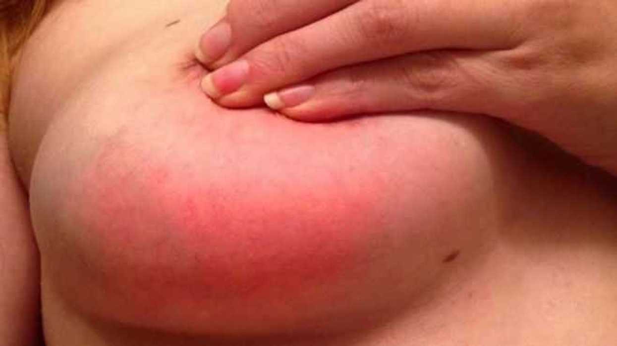 medidas-higienicas-pueden-ayudar-a-prevenir-algunos-tipos-de-mastitis