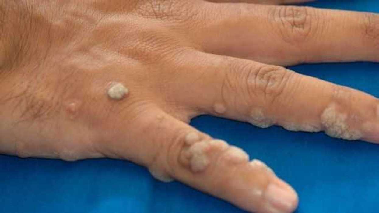 mezquinos-en-la-piel-advierten-presencia-del-virus-del-papiloma-humano