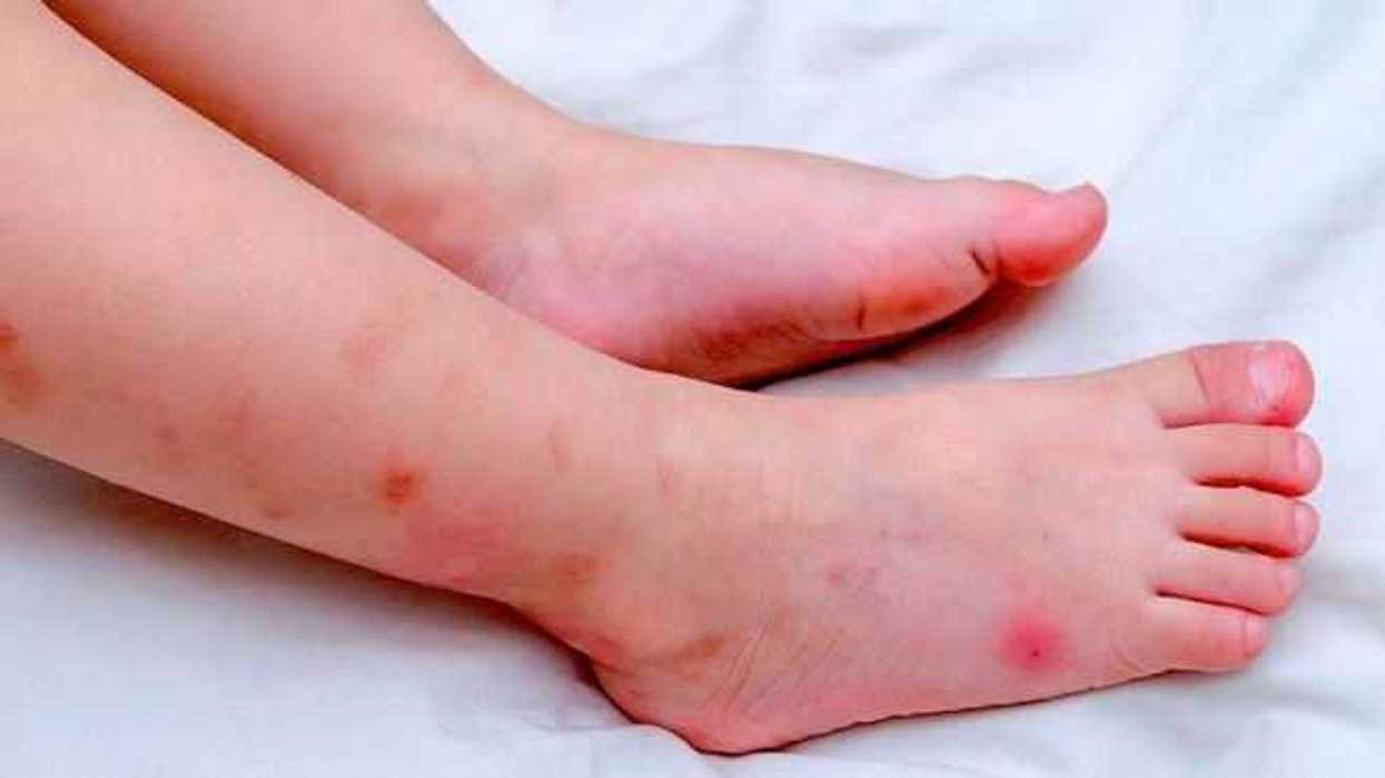 piden-evitar-automedicacion-ante-sospecha-de-dengue-zika-o-chikungunya