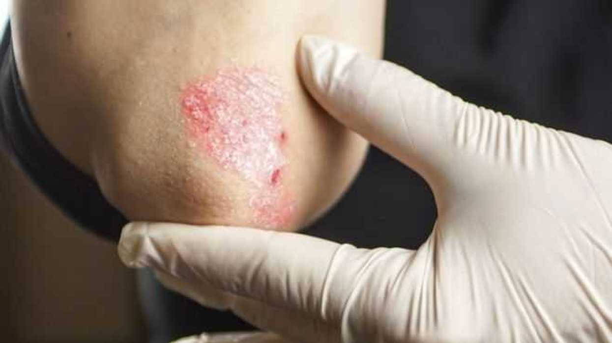 psoriasis-enfermedad-de-la-piel-con-impacto-fisico-y-emocional