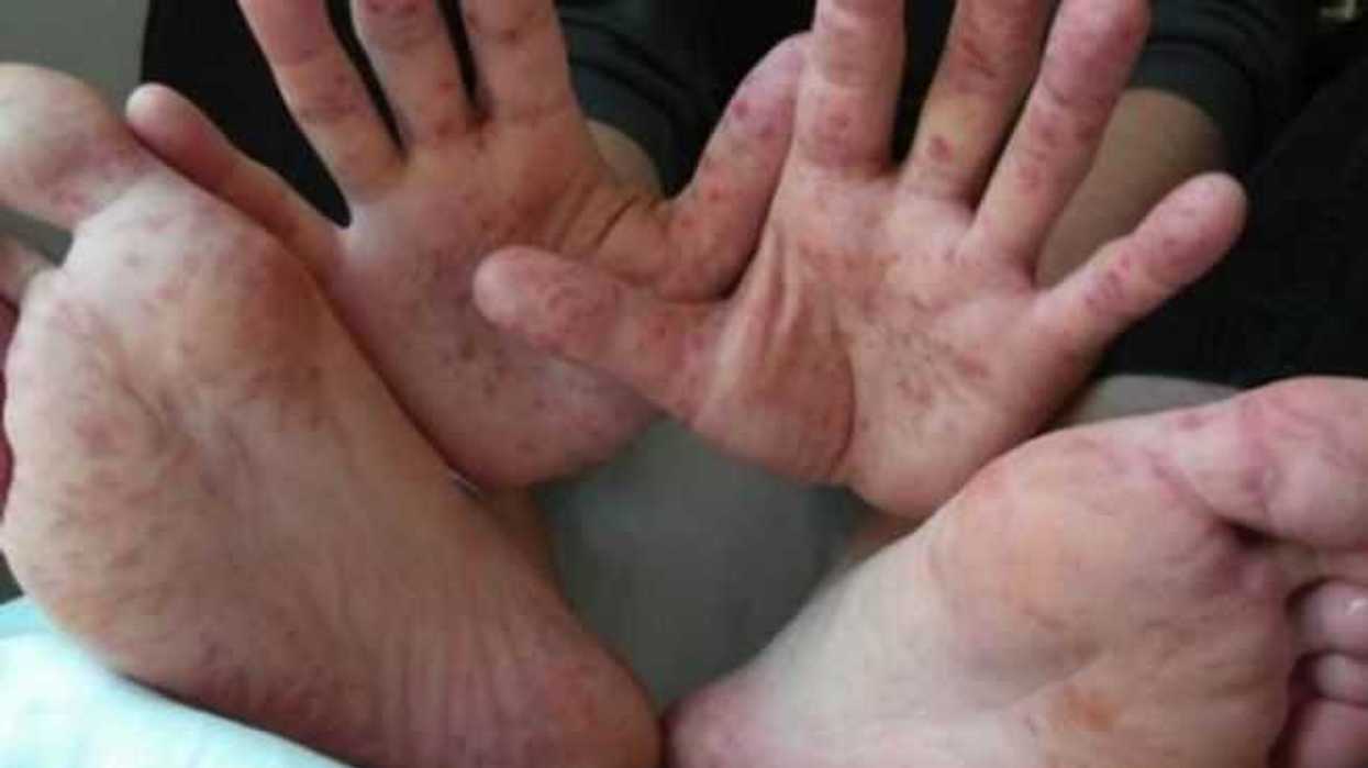 rechaza-salud-federal-alerta-epidemiologica-coxsackie