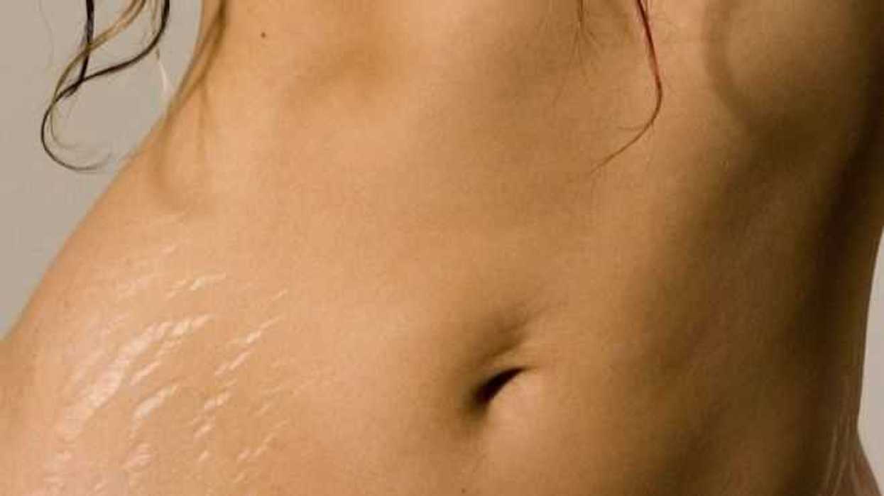 remedios-naturales-eliminar-las-estrias