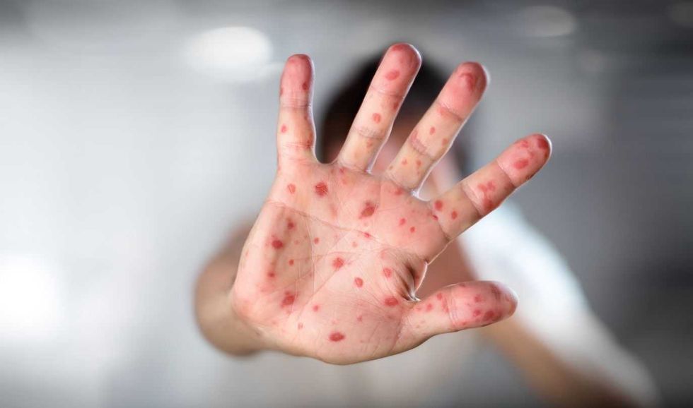 Sector Salud refuerza vigilancia epidemiológica ante alerta de Sarampión. Depositphotos.