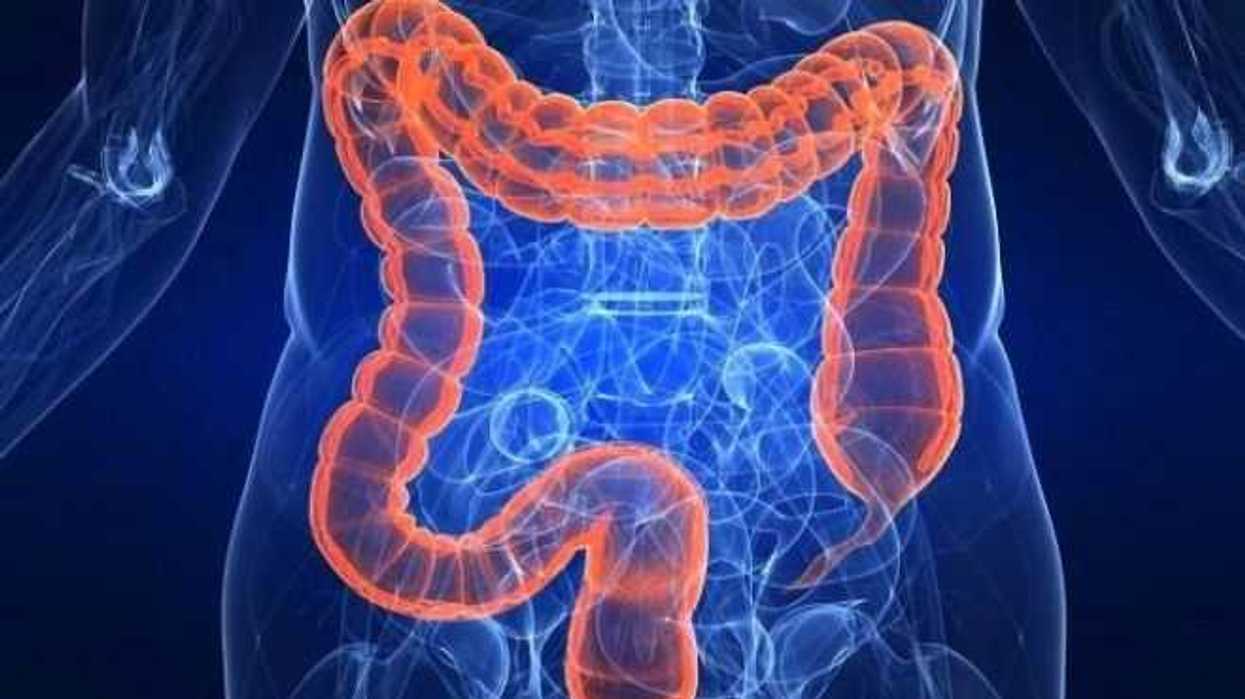 sindrome-de-lynch-aumenta-riesgo-de-tener-cancer-de-colon