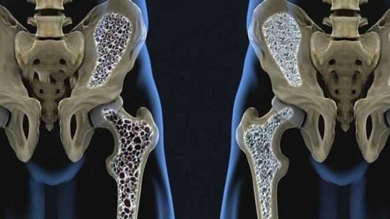 sufren-invalidez-tres-de-cada-10-personas-con-fractura-de-cadera
