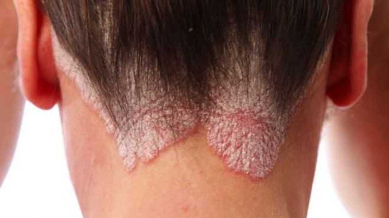 terapia-biotecnologica-contra-psoriasis-demuestra-beneficios