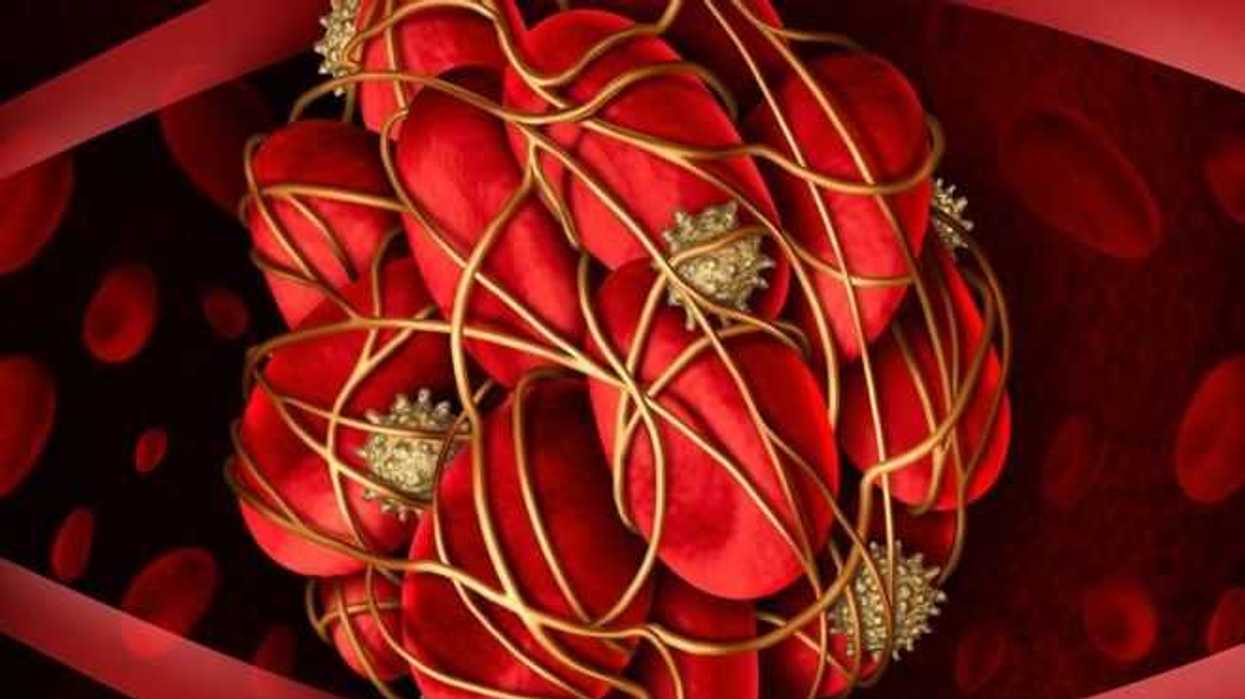 una-de-cada-cuatro-muertes-en-el-mundo-son-causadas-por-una-trombosis