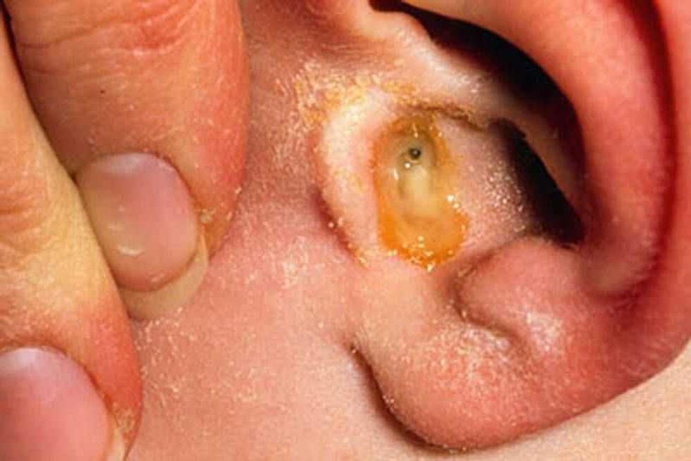 uso constante de audifonos y cotonetes podria ocasiona otitis2
