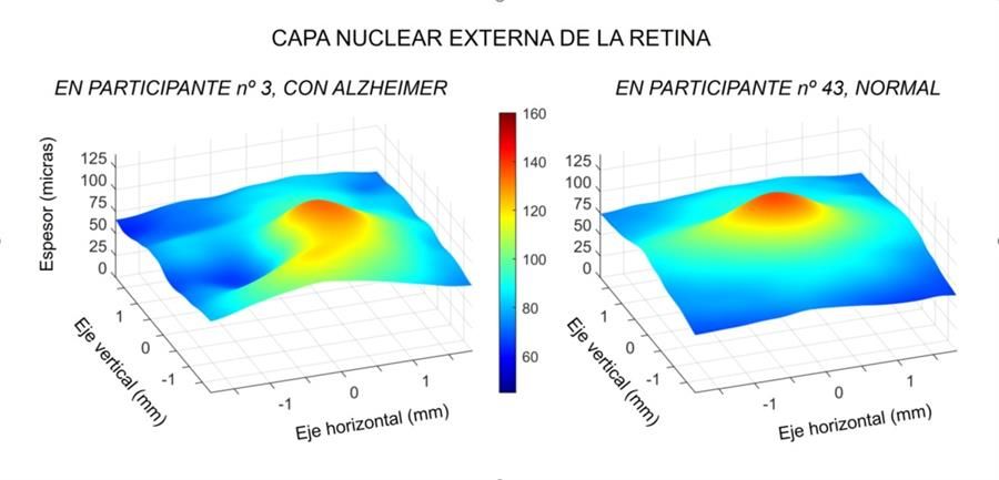 Las Arrugas En Las Capas De La Retina Un Indicador Del Alzhéimer 4637